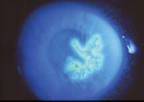 Fig. 2. Herpes simplex dendritic ulcer with sodium fluorescein stain shows a central absence of epithelial cells.