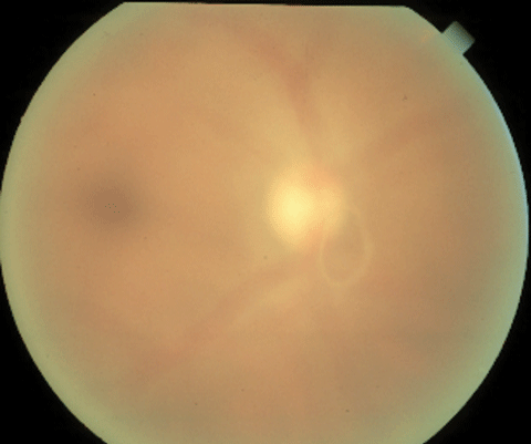 Weiss ring in an acute PVD causing a complaint of floaters.