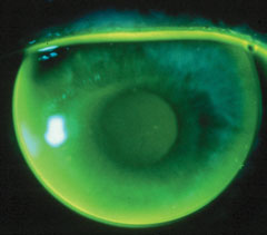 A well-fit aspheric multifocal gas permeable lens.