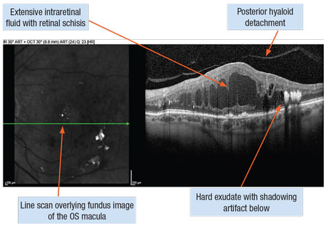 [First experiences with Navilas® s micropulse laser in the treatment of diabetic maculopathy]