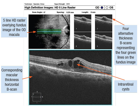Cystoid diabetic macula edema captured with SD-OCT line scans.