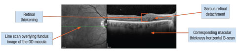 DME associated with serous retinal detachment.