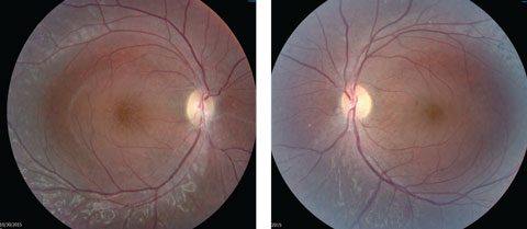 Figs. 2a and 2b. Our patient’s optic discs appeared normal, but do these fundus images point to the cause of his issue?