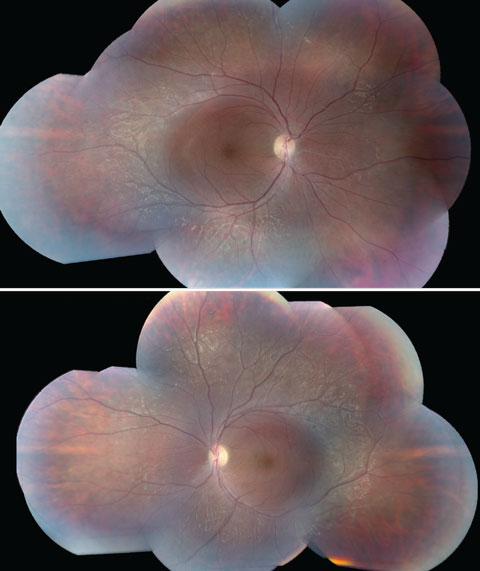 Figs. 3a and 3b. These fundus images of the left (above) and right eyes show white pigmentary changes of the RPE along the arcades as well as macular changes.