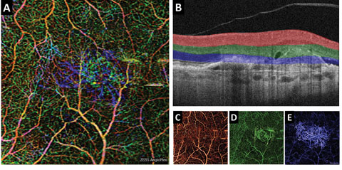(A) This color en face OCT-A image shows a combination of retinal layers in an eye with a choroidal neovascular membrane. (B) Shows the segmentation boundaries and color codes for each of the individual en face OCT-A images below. The en face OCT-A images are (C) the superficial retina (D) the deep retina and (E) avascular. 