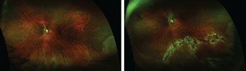 This retinal break with retinal detachment, seen post-treatment (right), was diagnosed using dilated funduscopy, but was not apparent pre-treatment (left) using UWFI. Photos: Jessica Steen, OD