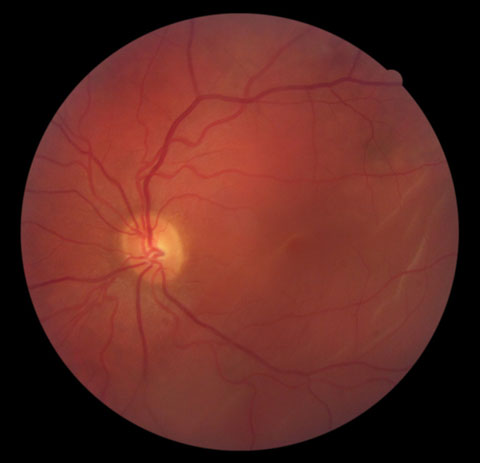 Research suggests retinal detachment, as seen here, is a common condition underlying optometric malpractice claims.