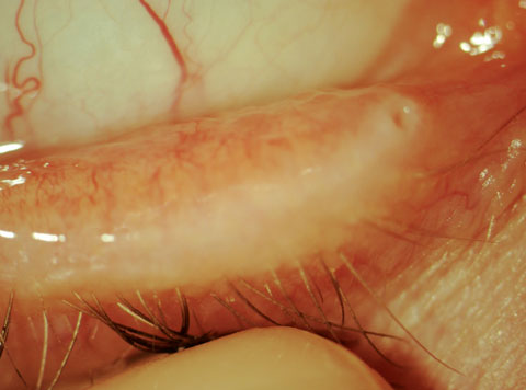 This patient displays nasal inferior papillary conjunctivitis in the right eye.