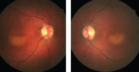 Figs 2a and 2b. These fundus photos show our patient from three years prior to the diagnosis. Can this presentation, combined with the current-day OCT, lead you to a diagnosis?