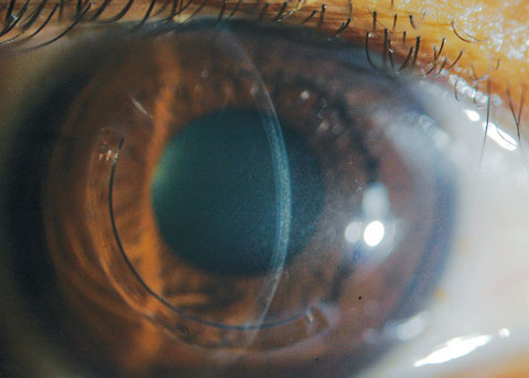 A slit beam shows the demarcation lines, which are a potential indicator of CXL treatment depth in a patient who received off-label treatment of CXL and an Intacs corneal implant (AJL Ophthalmic).