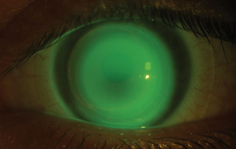 This patient was successfully fit in a hybrid contact lens after standard epithelium-off CXL.