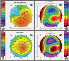 The same patient’s tomography 14 months after CXL treatment. It shows mild apical flattening on the axial map (upper left) and reduced elevations maps (anterior elevation, upper right; posterior elevation, bottom right).