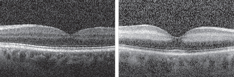 The increased reflectivity and thickening of the right eye’s nerve fiber layer (at right) is consistent with the acute phase of a retinal artery occlusion, contrasted with the appearance of the normal nerve fiber layer (at left) in the patient’s left eye.