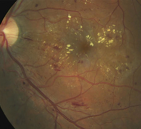 Scattered microaneurysms, intraretinal hemorrhages and nerve fiber layer hemorrhages, along with prominent exudate with clinically significant macular edema. The retinal architecture is partially obscured, indicative of macular thickening. Photo: Erik Hanson, MD
