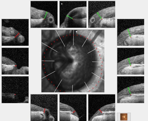The most recent images of this patient’s left eye demonstrate significant cupping and a markedly reduced ganglion cell layer overlying Bruch’s membrane opening, consistent with advanced glaucomatous disease.
