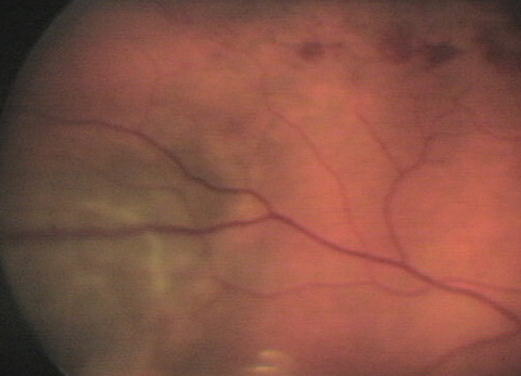 This 59-year-old hypertensive patient’s right eye shows findings that may explain his blurry vision. Can you diagnose him?