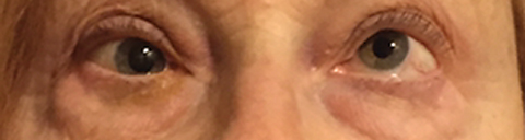 This patient presented with an acute partial pupil-involved third nerve palsy from an aneurysm. The picture shows compete restriction of the right eye on upgaze. 