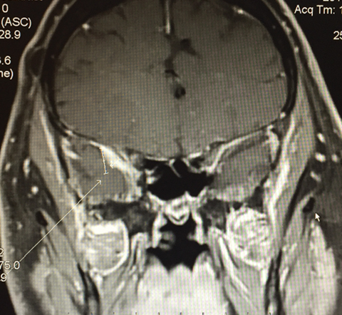 This is an MRI of a 71-year-old white male who presented with an acute isolated right fourth nerve palsy. The MRI shows dural thickening abutting the cavernous sinus and possible compression of the fourth nerve within the cavernous sinus.
