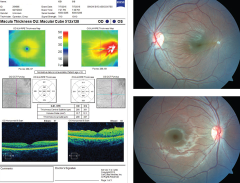 This 11-year-old patient appeared for his first eye exam with blurry vision in his left eye, shown in the bottom fundus image. Can you identify the cause?