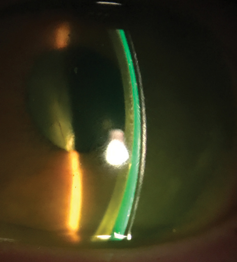 Pathologisch Gunst Met opzet The Right Fit for the Irregular Cornea: Smooth Things Over with Scleral  Lenses