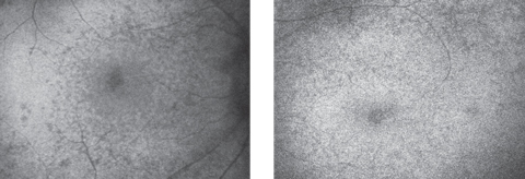 Fig. 2. Autofluorescence of the right (at left) and left maculae.
