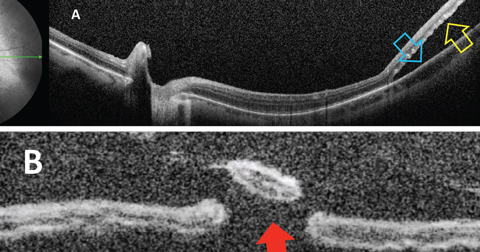 Fig. 1. Optical coherence tomography showing (A) separation of neurosensory retina (yellow arrow) from the RPE  (blue arrow); (B) percolated retinal break (red arrow).