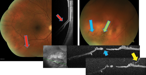 Fig. 2. This patient with preexisting lattice (green arrow), developed a retinal break (blue arrows) during PVD (yellow arrow), resulting in an inferior retinal detachment (red arrows).