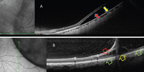 Fig. 4. OCT is helpful in differentiating RRD from retinoschisis. (A) Neurosensory retina is separated from RPE in RRD. This patient requires surgical intervention. (B) In retinoschisis, separation and spilling of neurosensory is seen. Normal apposition of the outer retina to RPE is seen (green arrows) on either side of the outer retinal break (yellow arrow). This patient may be closely monitored. 