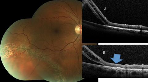 Fig. 6. This asymptomatic patient with subclinical RRD not involving the macula is effectively treated by laser bordering. The alteration of the outer retina-RPE junction can be noted when the pretreatment OCT (A) is compared to the posttreatment scan (B) (blue arrow). 