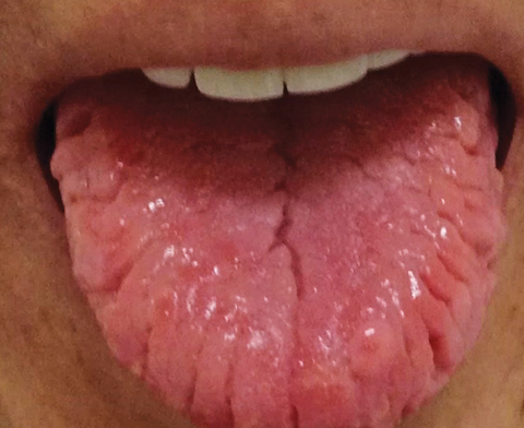 A sore, cracked tongue is suggestive of Sjögren’s syndrome. 