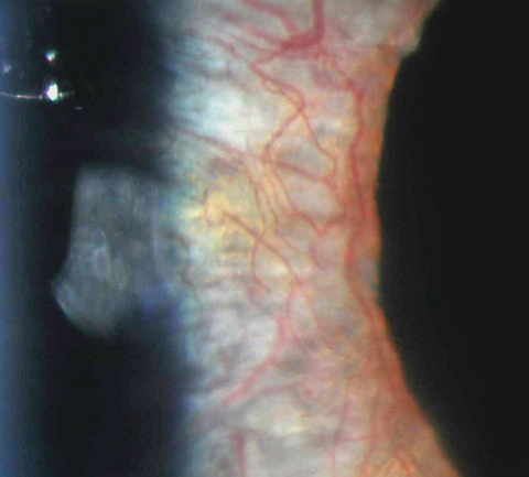 Marked neovascularization of the iris in this patient was caused by uncontrolled proliferative diabetic retinopathy. Photo: Aaron Bronner, OD