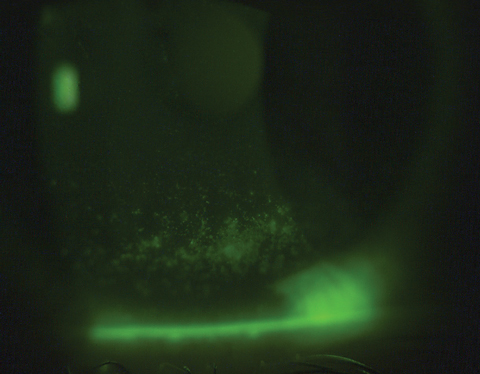 Sodium fluorescein corneal staining of a Sjögren’s syndrome patient prior to scleral contact lens wear.