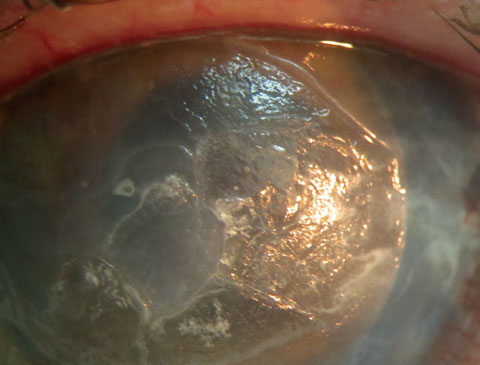 This patient displays band keratopathy in a pre-phthisis non-seeing right eye. EDTA-assisted removal was initiated to resolve the non-healing central defect. 