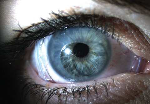 Virtually any corneal or conjunctival surface disease that involves inflammation may benefit from the use of an amniotic membrane.