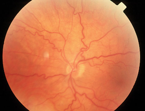 Veias da retina dilatadas e tortuosas numa oclusão venosa iminente.