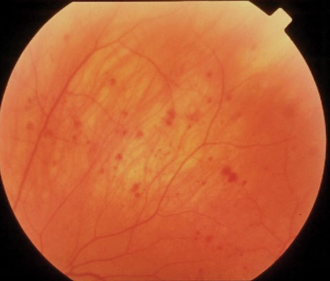 venous stasis retinopathy causes