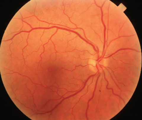 venous stasis retinopathy vs ocular ischemic syndrome