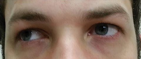 Fig. 3. Extraocular motilities revealed restriction in dextroversion.