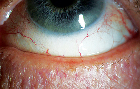This 65-year-old woman presented with frequent dryness and irritation, and she reported a “dry eye diagnosis” from a previous practitioner. A closer look at her lid margin suggests blepharitis is at play here as well.