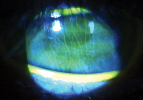 An Ods Guide To Postoperative Cataract Care - 