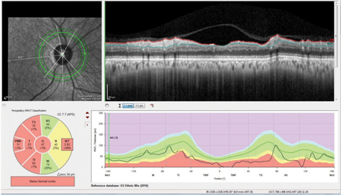 Fig. 1. The neuro protocol retinal nerve fiber layer circle scan with the papillomacular bundle (PMB) represented in the center of the double hump plotting we are used to viewing, as opposed to the standard RNFL circle scan which has the papillomacular bundle at the ends of the double hump plot. Note also the segmentation of the papillomacular bundle in the Garway-Heath sector analysis in this patient with non-glaucomatous optic neuropathy.