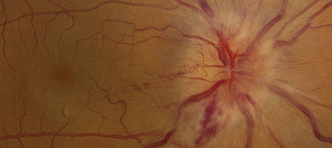 This patient displays optic nerve swelling and a neurosensory retinal detachment in the right eye.