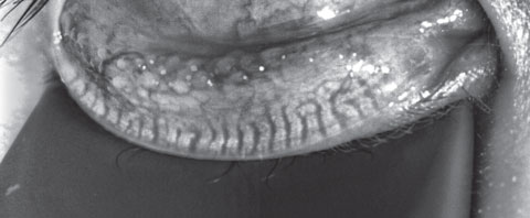 Fig. 3. This patient’s meibography shows a patient with first-degree gland atrophy indicating less than 25% gland loss via the Pult scale.