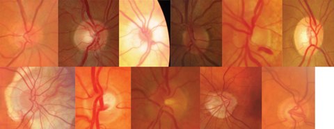 Optic nerves come in all shapes and sizes, making the ISNT rule tough to follow. Can you tell which are normal, anomalous but non-glaucomatous and glaucomatous? Photos: Jarett Mazzarella, OD