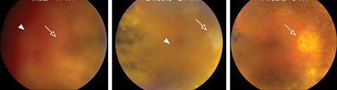 This patient with Stage III NIV has significant vitreous hemorrhage (arrow heads) and vision reduced to count fingers. At left is initial presentation, while the middle and left images are two and four weeks after Avastin injection, respectively. At two weeks, the vitreous hemorrhage was resolved and vision improved to 20/70. By four weeks, vision was 20/50 and the optic nerve head (open arrow) is visible. Photo: Vinit B. Mahajan MD, PhD