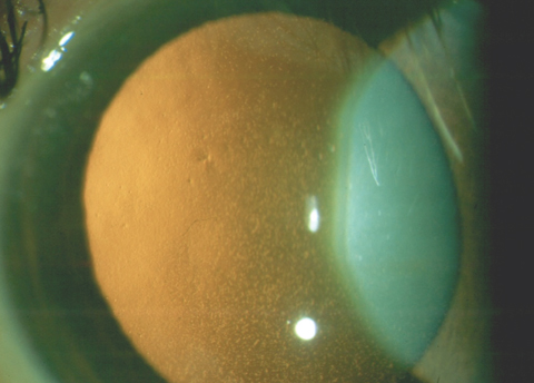 This patient has confluent central guttae from FED. Even though the cornea retained normal thickness, the patient’s vision was reduced to 20/30 due to the visual degradation from the guttae.