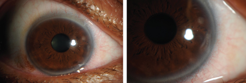 Figs. 7 and 8. Contact lens-induced peripheral corneal infiltrates.