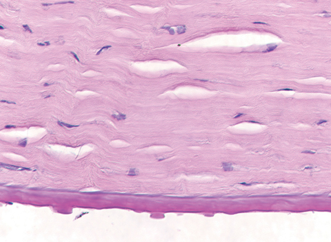 Fig. 3. This specimen, removed following corneal transplantation, shows the histopathology of corneal guttae. Note the Descemet’s membrane thickening, also a hallmark of FED.