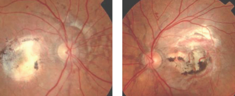 Fig. 1. This patient has angioid streaks that radiate from the optic disc, in addition to macular laser scarring and blot hemes.