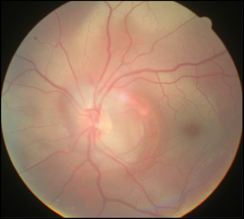 Fig. 4. Traumatic choroidal rupture may also injure Bruch’s membrane, leading to CNV.